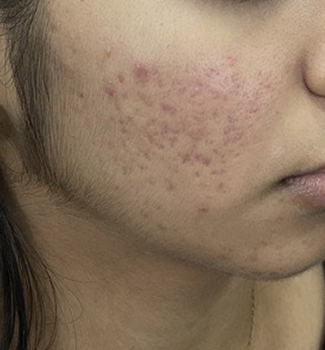 acne before