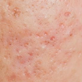 acne