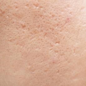 acne