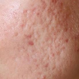 acne